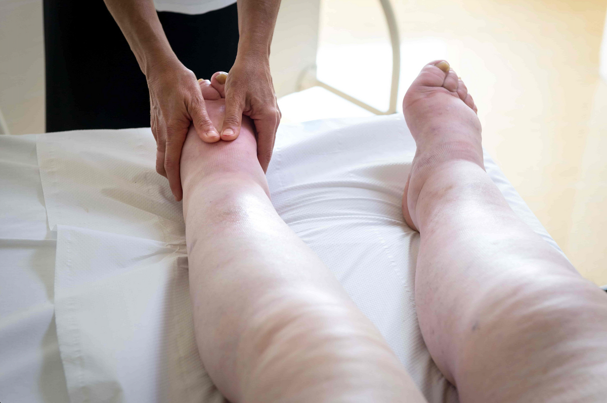 Do Diuretics Help With Edema? What Works and What Doesn’t - Daily Defense