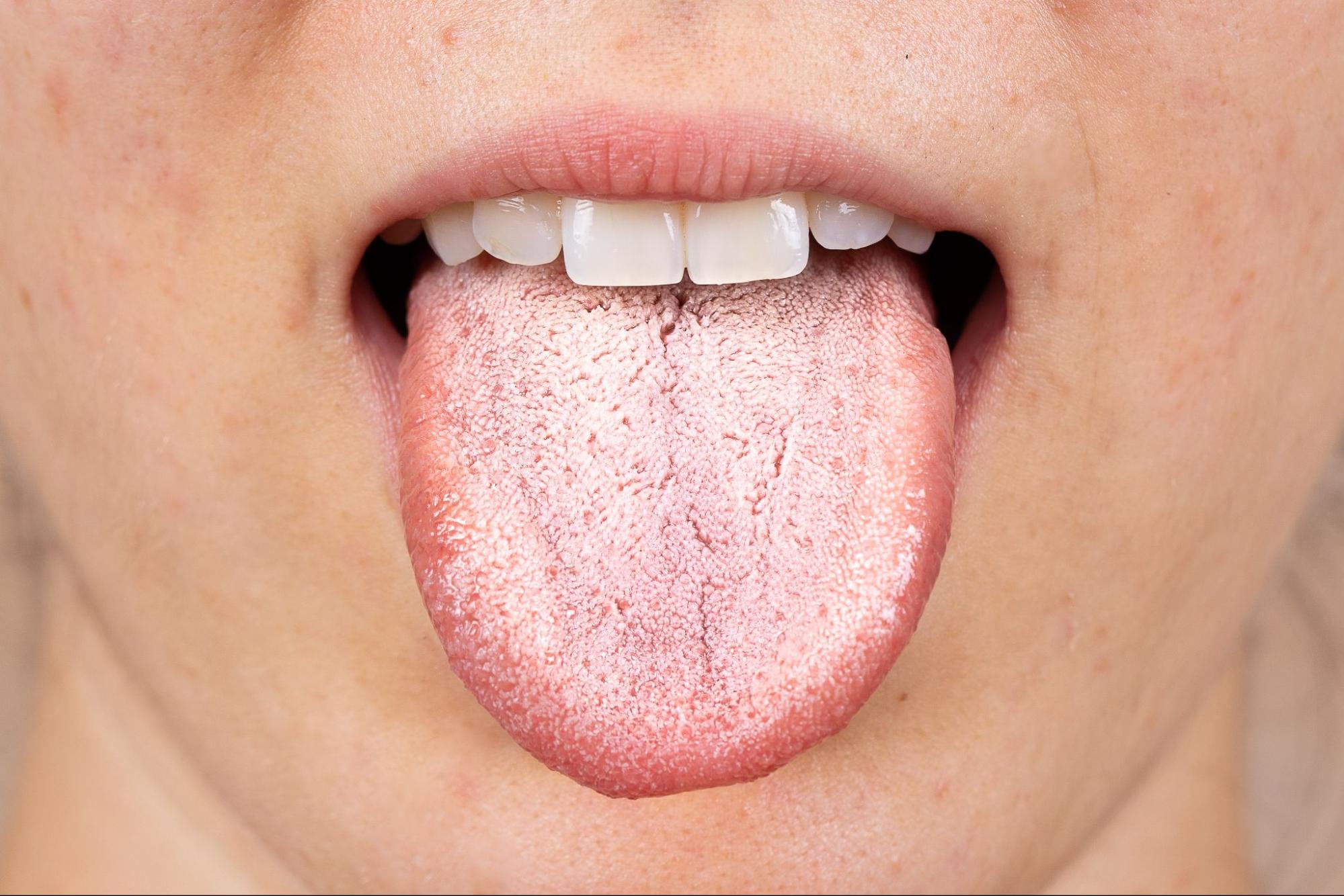 What Supplement Is Best For Candida? - Daily Defense